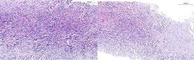 Update in collecting duct carcinoma: Current aspects of the clinical and molecular characterization of an orphan disease